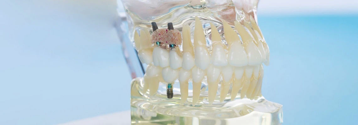 Наращивание костной ткани (аугментация) в Киеве 1 картинка