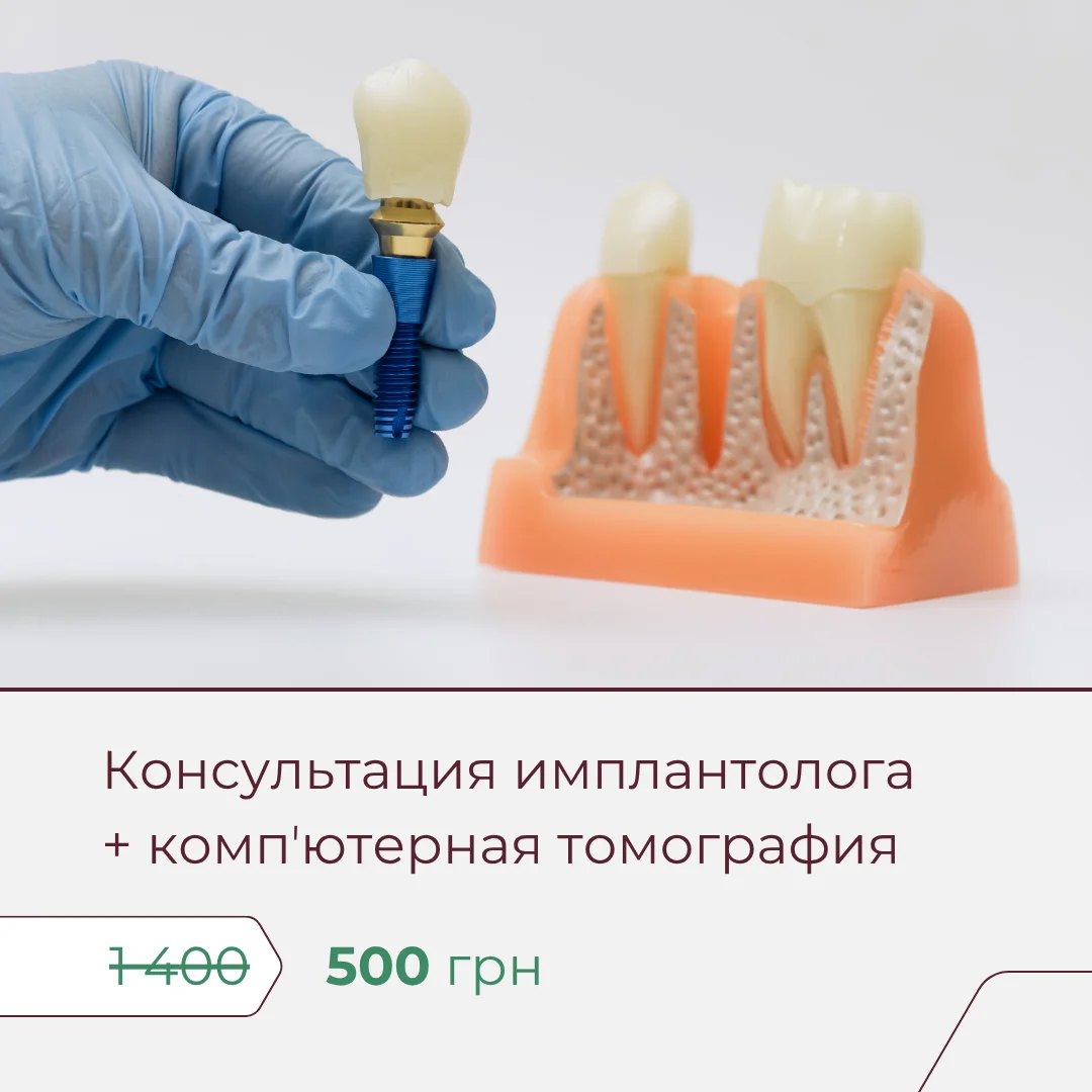 Имплантация зубов 2 картинка